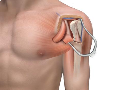 Técnica quirúrgica de la placa para el húmero proximal Polarus [continuación] 3 Abordaje Haga una incisión en la fascia a lo largo del borde lateral del músculo coracobraquial y retráigala