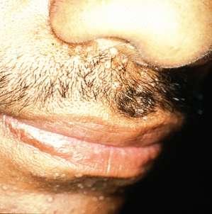 Infección cutánea secundaria: las lesiones comienzan como pequeñas pápulas, ulceran, abscesos, nódulos eritematosos