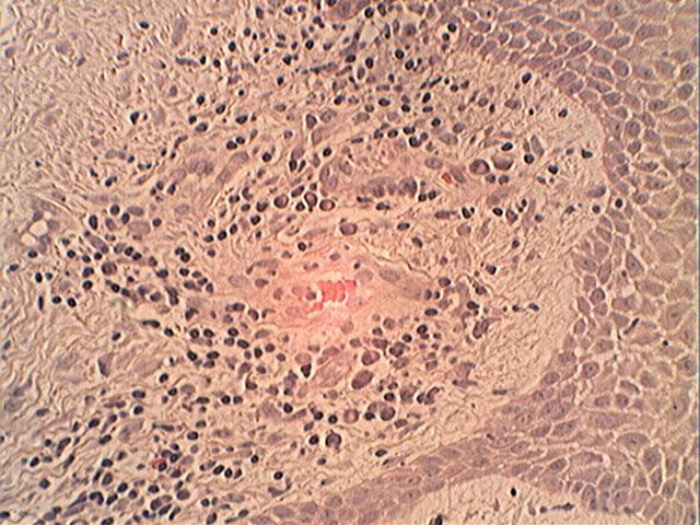 Resultados 41 En la figura 7 podemos observar parte del epitelio, aún con crestas epiteliales, son poder reconocer nítidamente la capa basal.