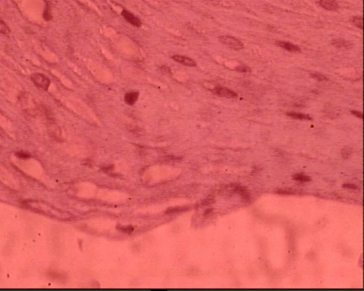 En la parte superior de la imagen se reconoce una parte de una cresta epitelial borrada por el infiltrado inflamatorio.
