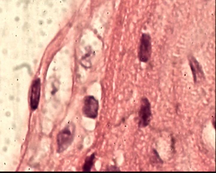 En la figura 11 podemos ver el edema intracelular muy marcado, acompañado de alteraciones nucleares.