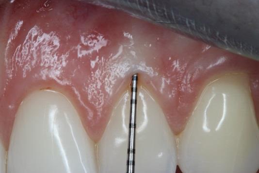 un biotipo fino. Además se ha determinado una mayor prevalencia de recesión gingival en biotipos delgados después de tratamientos periodontales (33, 37).