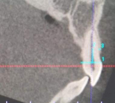 Figura 13: Medición de la cortical ósea vestibular a 6mm del LAC en sujeto de la