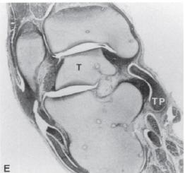 En la secciones posteriores a las que se muestran en la Fig. 23 A y B, la capa profunda del ligamento deltoideo en ambos pies parece haber sido jalada entre el astrágalo y el maléolo medial.