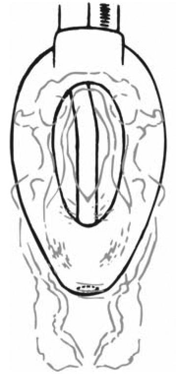 4 La posición del tubo de drenaje en el interior del manguito impide que la epiglotis ocluya el tubo de la vía aérea. Esto elimina la necesidad de utilizar barras elevadoras de la epiglotis.