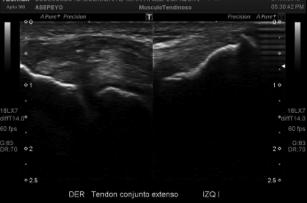 Radiology 1995; 196: 43-46 17 Tennis CURSO elbow: TEÓRICO-PRÁCTICO the surgical treatment DE of lateral ECOGRAFÍA epicondylitis MÚSCULO-ESQUELÉTICA EN EL Nirchl DEPORTE RP, Pettrone FA. J.