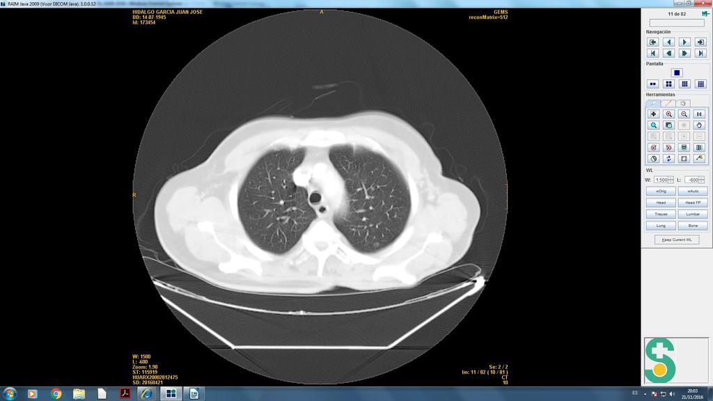 Caso clinico (3) ABRIL-2016: SE REMITE A ONCOLOGIA POR PROGRESION PULMONAR - TAC (ABRIL-2016) -Milimetricos nódulos pulmonares
