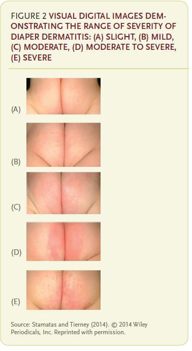 Presentación clínica: Área afectada: glúteos, perianal, muslos y cintura Eritema: leve,