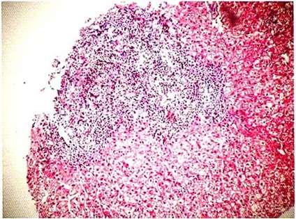 AIH. AP AIH aguda Hepatitis lobular Necrosis centrilobular Menos común: cirrosis