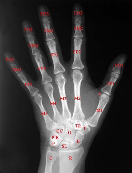 92 Los dedos son los órganos esenciales de prensión y del tacto, muy móviles. Sus huesos están articulados con los metacarpianos y también se numeran del 1 a 5 comenzando por el pulgar.