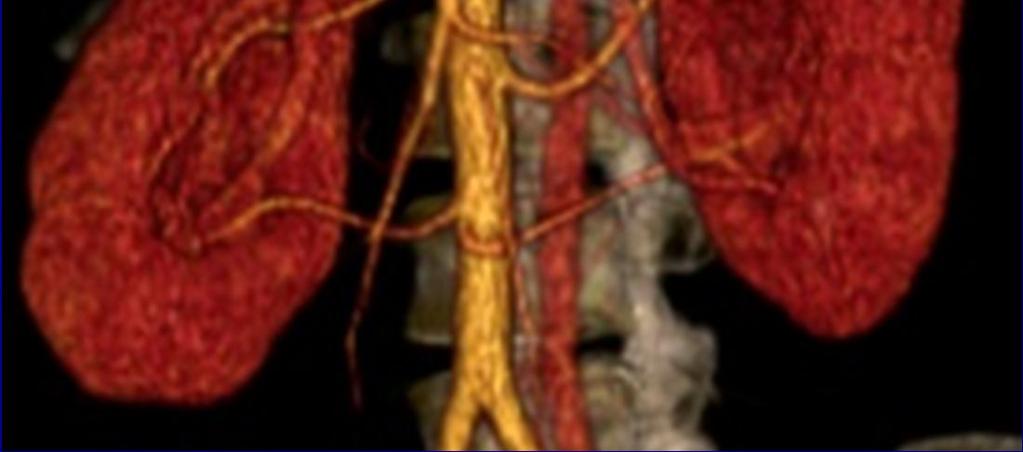 Impronta parenquimatosa en el seno renal, debido a la dilatación de la vía urinaria.