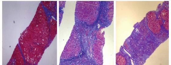 D I S C U S I O N Figura 15. Estudios histológicos. A: Septos adelgazados; B: engrosamiento septal y nódulos grandes; C: micronodularidad.