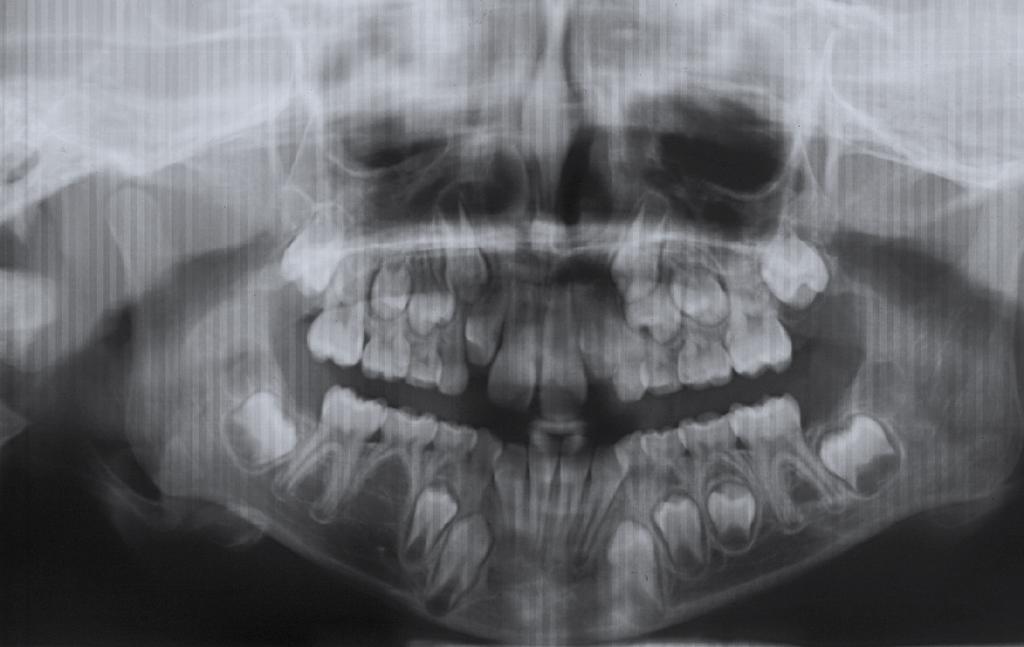 Estudio transversal de hipodoncias no sindrómicas en una muestra de pacientes infantiles > Figura 1. Imagen radiográfica de agenesia del segundo premolar inferior derecho.