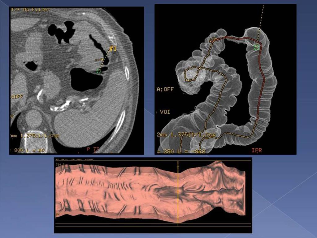 Fig. 15: Se confirma la presencia de una lesión que estenosa de forma significativa la luz del colon, próxima al ángulo esplénico,a unos 75 cm del margen