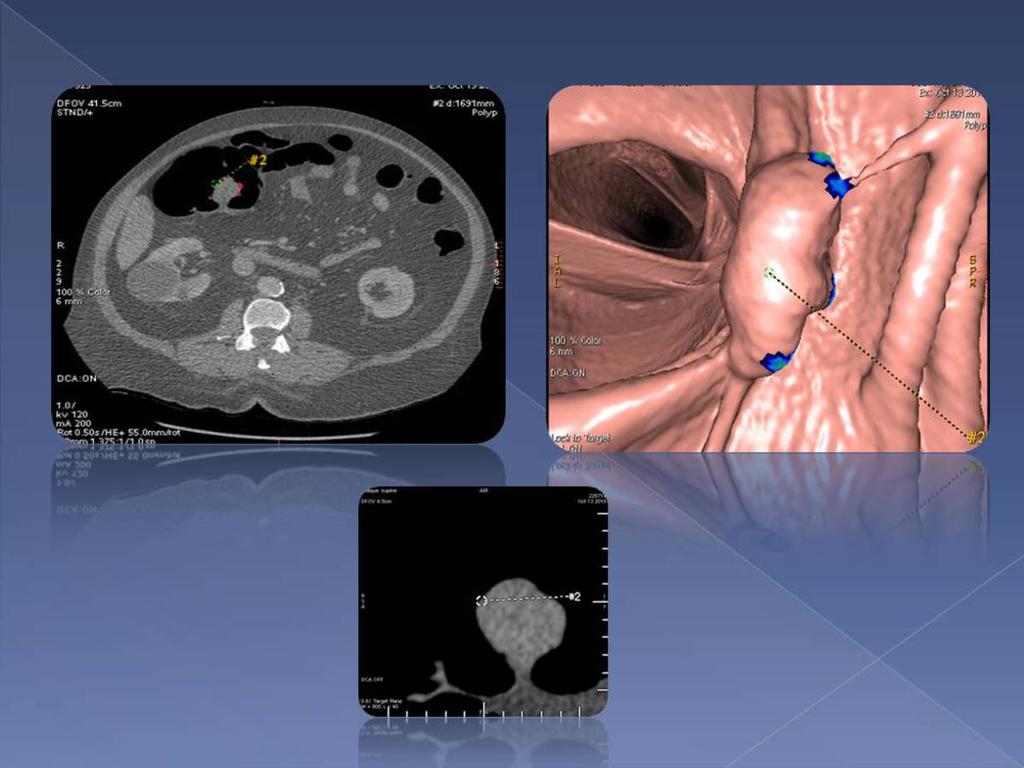 Fig. 6: Se identifica en la colonoscopia virtual un pólipo de aproximadamente 4cm, situado en colon ascendente proximal-transverso.