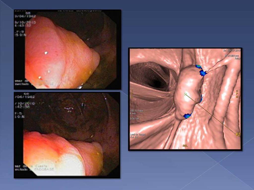 Fig. 7: Se identifica en la colonoscopia virtual un pólipo de aproximadamente 4cm, situado en colon ascendente proximal-transverso.