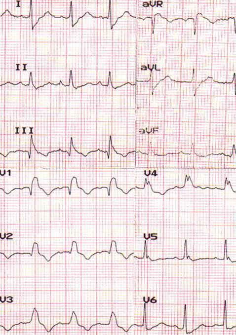 Electrocardiograma: De interés,fundamentalmente, para descartar un IAM.