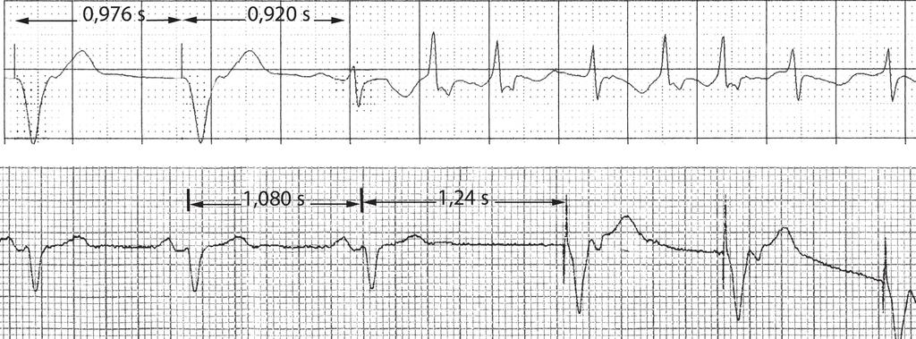Capítulo 32 - Principios básicos y electrocardiografía de los dispositivos de estimulación eléctrica cardíaca 32-2 Función de detección en el marcapasos unicameral (VVI). Derivación II.