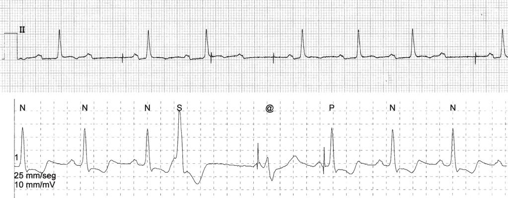 Capítulo 32 - Principios básicos y electrocardiografía de los dispositivos de estimulación eléctrica cardíaca 32-5 Falla de captura.