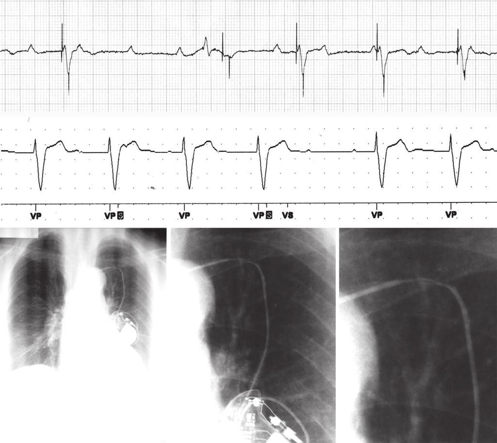Capítulo 32 - Principios básicos y electrocardiografía de los dispositivos de estimulación eléctrica cardíaca 32-8 Sobredetección. Marcapasos VVI. Derivación II.