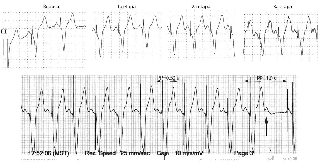 Capítulo 32 - Principios básicos y electrocardiografía de los dispositivos de estimulación eléctrica cardíaca 32-11 Seguimiento auricular. Derivación II, ejercicio físico en banda sin fin.
