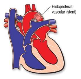 Stents Endovasculares En la coartación de aorta, la estenosis de la pulmonar, lesiones traumáticas arteriales, disección arteria cerebrales,enfermedad renovascular enfermedad, estenosis quirúrgica,