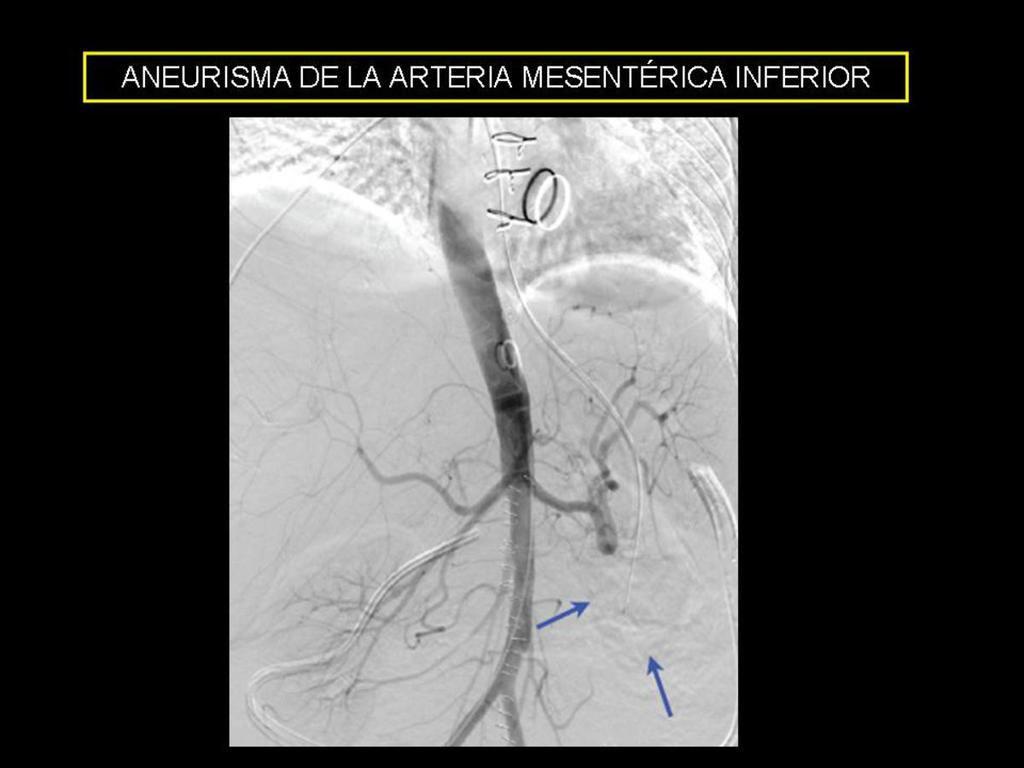 Fig. 7: Mujer de 55 años intervenida de hemicolectomía derecha por isquemia intestinal con estenosis de la arteria mesentérica superior y sustitución valvular mitral.