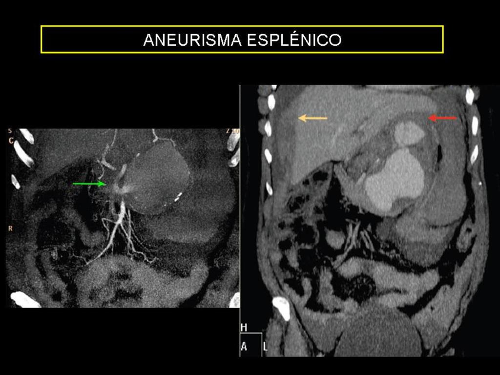 Fig. 3: Mujer de 67 años con aneurisma de la arteria esplénica ya conocido por exploraciones previas. Ingresa por shock con sospecha de rotura del aneurisma.