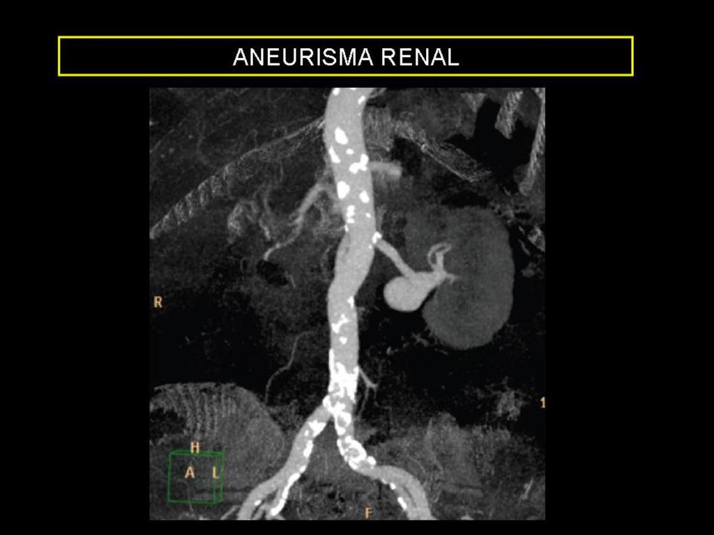 Fig. 4: Mujer de 73 años en TC torácico por aumento de tamaño hiliar derecho se identificó un aneurisma de la arteria renal derecha.