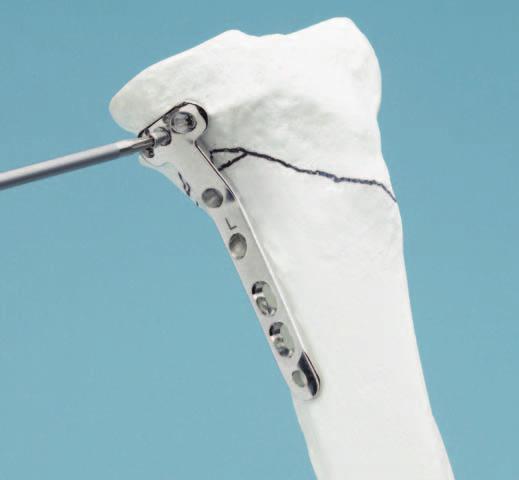 Técnica quirúrgica Medición de la longitud del tornillo La longitud del tornillo se determina con el medidor de profundidad.