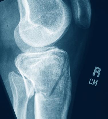 cizallamiento del cóndilo tibial interno, las fracturas mediales por cizallamiento con hundimiento asociado, y las fracturas por