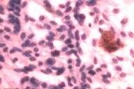 El moco se observa en el adenocarcinoma Identificar