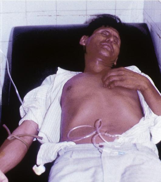 Figure 214-4 A Peruvian patient with severe cholera.