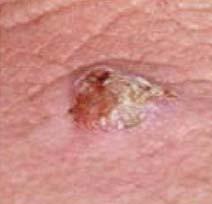 En Estados Unidos el cáncer de piel es el más común y cada día se presentan nuevos casos.