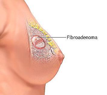 Figura 10. Fibroadenomas en la mama Fuente: ( University of Southern California, 2015) A menudo, los tumores se vuelven más pequeños después la menopausia (si la mujer no está tomando hormonoterapia).