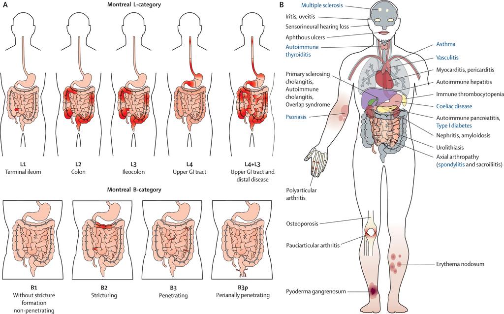 Manifestaciones extraintestinales: Artritis y artralgias Eritema nodoso Pioderma