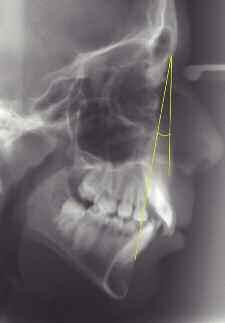 Ángulos S y S La disposición del maxilar línea () y de la mandíbula línea () en relación a la base del cráneo (línea S) viene