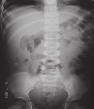 Apendicitis epiploica CASO CLÍNICO Niño de 10 años de edad, que acude a urgencias por presentar dolor cólico abdominal en la fosa ilíaca derecha, de tres días de evolución, acompañado de fiebre de 38