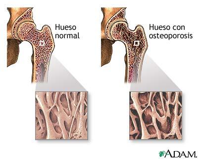 Enfermedad metabólica ósea Osteopenia y osteoporosis Osteopenia inicial Inflamación