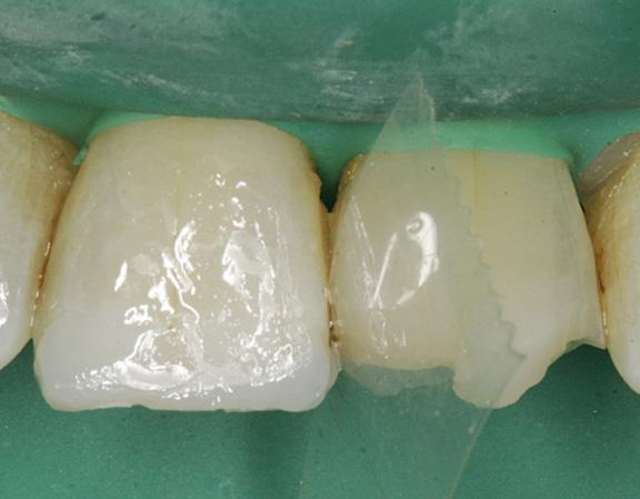 El composite Nano Híbrido contiene un agente fluorescente que asegura la apariencia natural del diente y es de muy fácil manipulación.