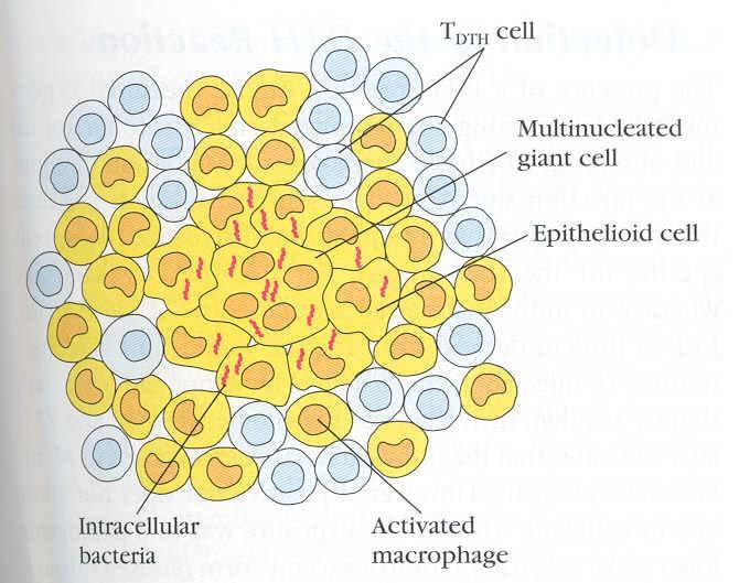 Linfos T Células gigantes multinucleadas Células