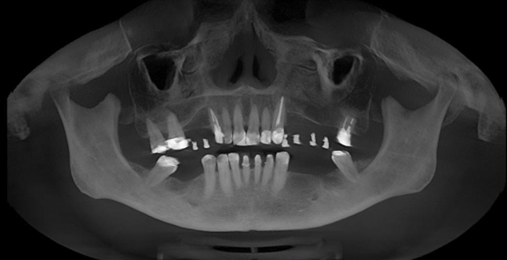 63 7.2 ANÁLISIS IMAGENOLÓGICO Figura 27. Vista panorámica A nivel del hueso maxilar se observan zonas la neumatización de los senos maxilares.