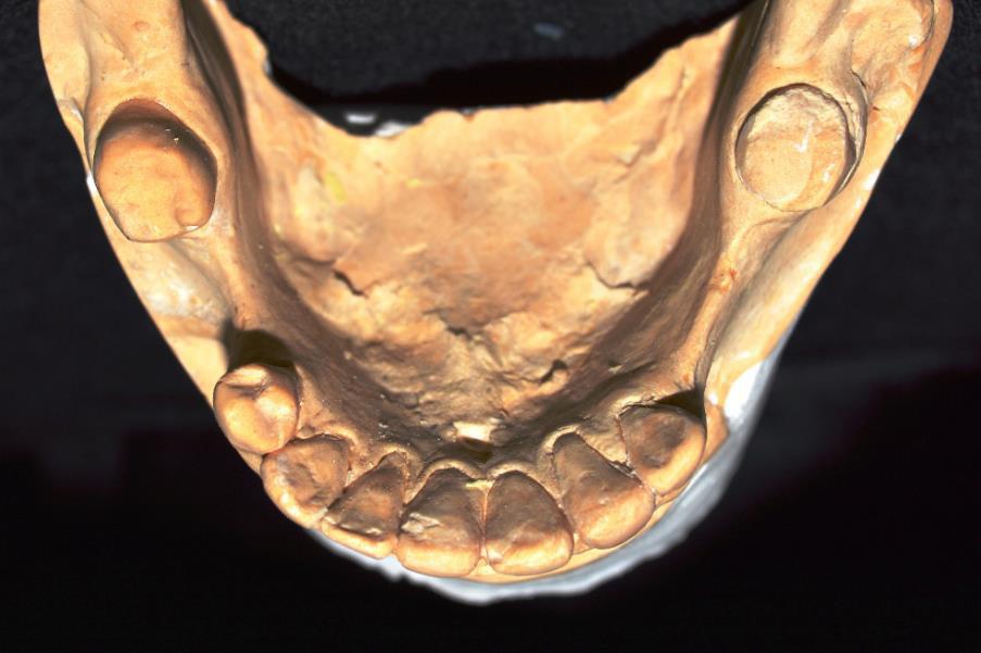 3, dentición permanente incompleta. Rebordes edéntulos con pérdida ósea horizontal.