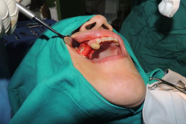 73 3.4 TRATAMIENTO REALIZADO Después de la Fase I periodontal.