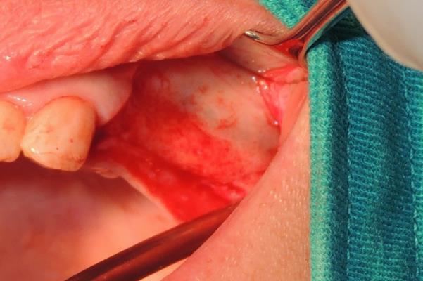 Anestesia Infiltrativa en el fondo de surco, y en el paladar Incisiones Figura