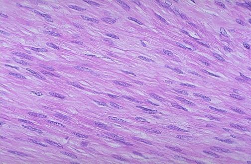 Leiomioma Fascículos de células fusiformes.