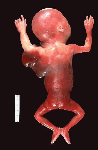 Linfangioma El feto presenta una masa que toma el brazo y parte del pecho.