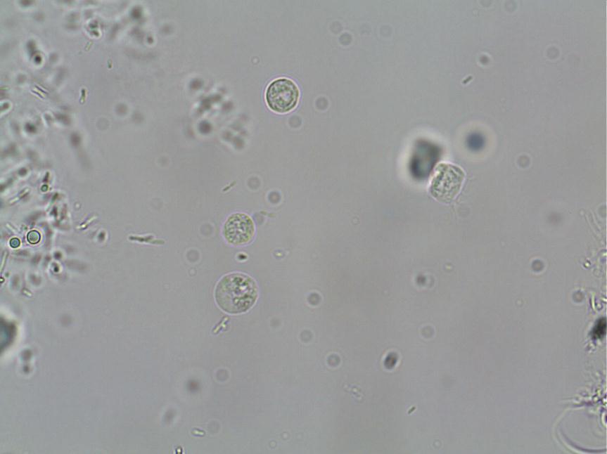 LEUCOCITOS Normal: hasta 3 leucos x campo Mayor tamaño que los eritrocitos, forma esférica y color gris oscuro, pueden aparecer de forma aislado o en acumulos.