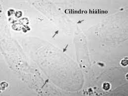 CILINDROS HIALINOS Proteína de T-H.