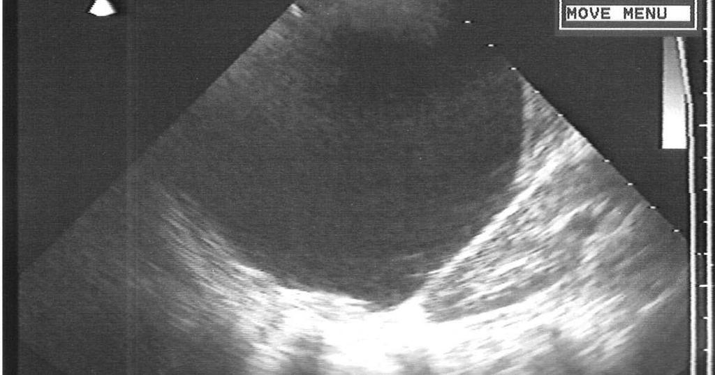 RX de sistema: punta distal fija EcografÍa abdominal: pseudioquiste en